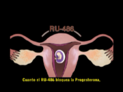 ABORTO QUÍMICO CON LA PÍLDORA ABORTIVA