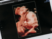 DECENAS DE MILES DE ABORTOS A BEBÉS EN SU 15 SEMANA DE GESTACIÓN Y QUE SIENTEN DOLOR, SE LLEVAN A CABO CADA AÑO